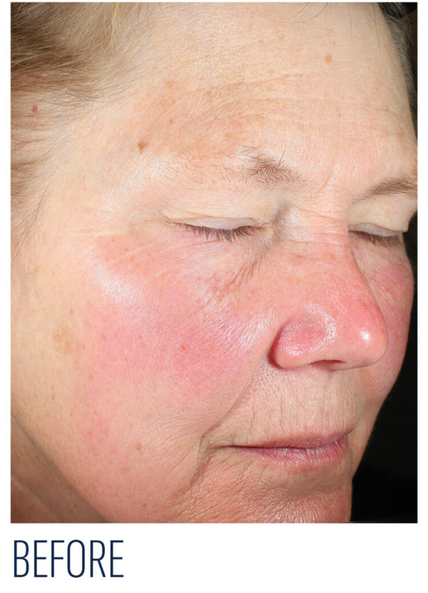 Before skincare treatment showing mature skin texture -Vos Collection