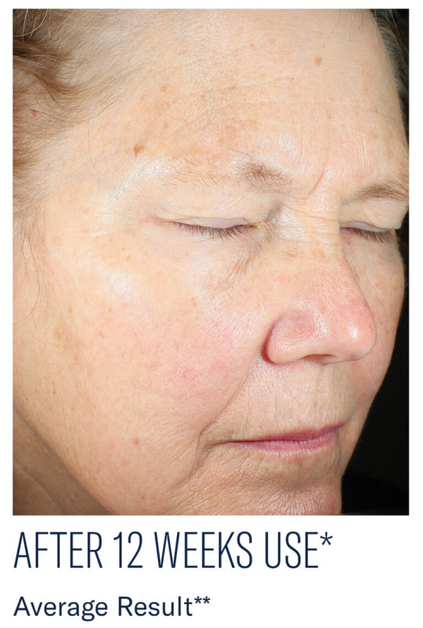 After 12 weeks use, visible skin texture improvement with reduced fine lines -Vos Collection